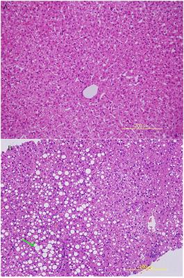 Histopathological Features and Composition of Gut Microbiota in Rhesus Monkey of Alcoholic Liver Disease